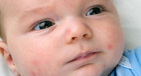 acne bij baby's